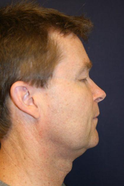 Facelift Before & After Patient #3073