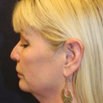 Facelift Before & After Patient #3074