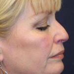 Facelift Before & After Patient #3074