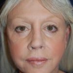 Facelift Before & After Patient #3109