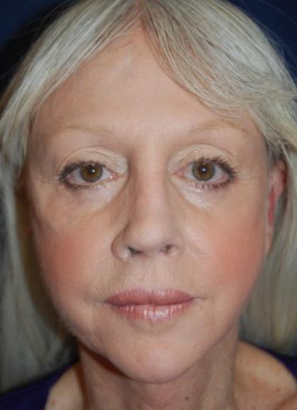 Facelift Before & After Patient #3109