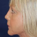 Facelift Before & After Patient #3109