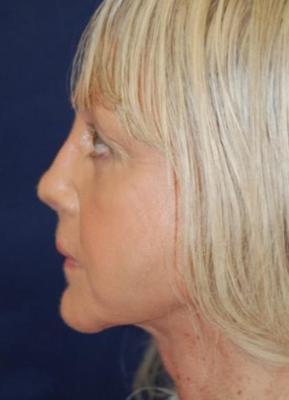 Facelift Before & After Patient #3109