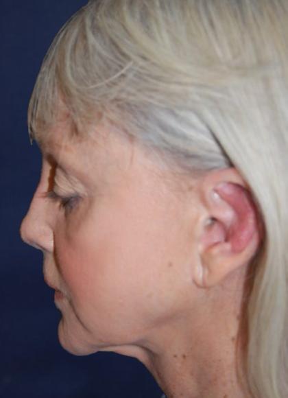 Facelift Before & After Patient #3109