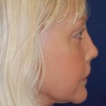 Facelift Before & After Patient #3109