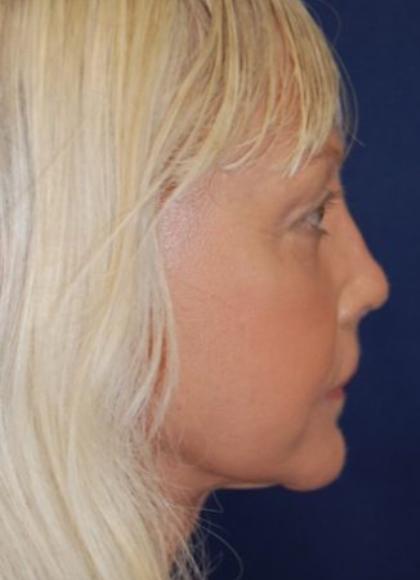 Facelift Before & After Patient #3109