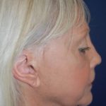 Facelift Before & After Patient #3109