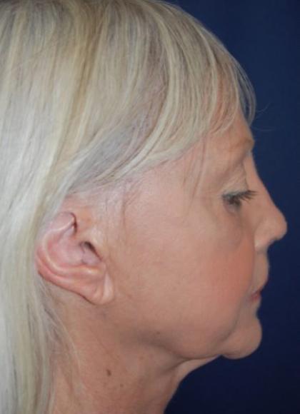 Facelift Before & After Patient #3109