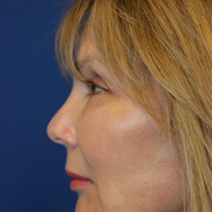 Rhinoplasty Before & After Patient #1769