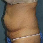 Tummy Tuck Before & After Patient #1832