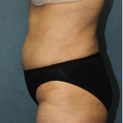 Tummy Tuck Before & After Patient #1832