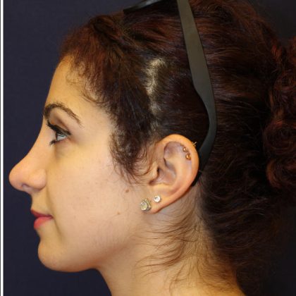 Rhinoplasty Before & After Patient #1509