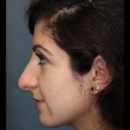 Rhinoplasty Before & After Patient #1509