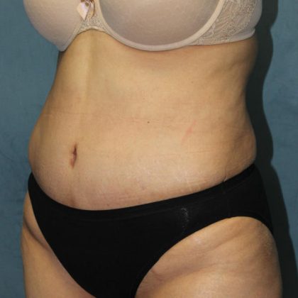 Tummy Tuck Before & After Patient #1832