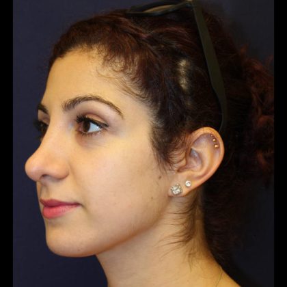 Rhinoplasty Before & After Patient #1509