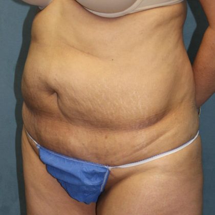 Tummy Tuck Before & After Patient #1832