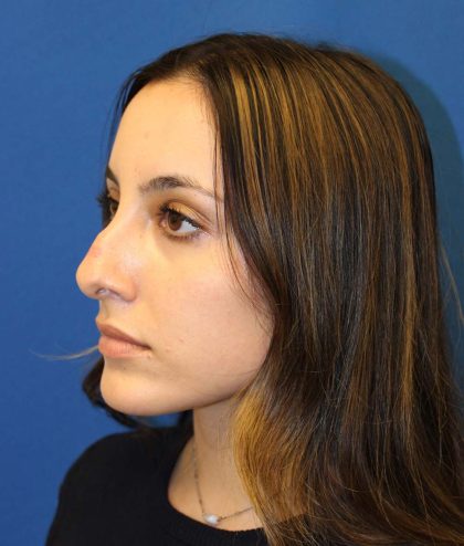 Rhinoplasty Before & After Patient #3573