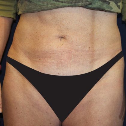 Liposuction Before & After Patient #1796