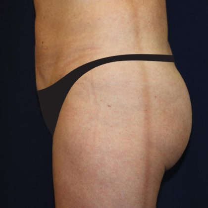 Liposuction Before & After Patient #1796