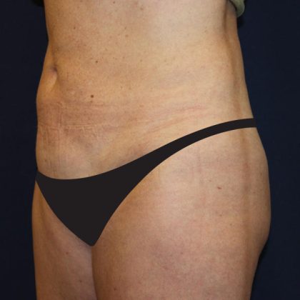 Liposuction Before & After Patient #1796