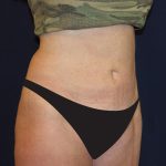 Liposuction Before & After Patient #1796