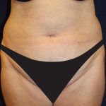 Liposuction Before & After Patient #1796