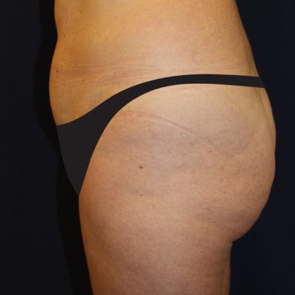 Liposuction Before & After Patient #1796