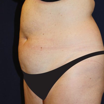 Liposuction Before & After Patient #1796