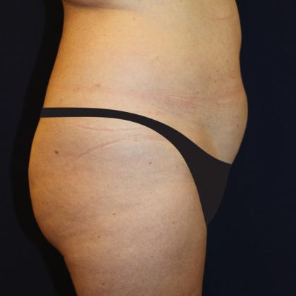 Liposuction Before & After Patient #1796