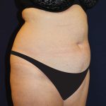 Liposuction Before & After Patient #1796