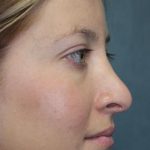 Rhinoplasty Before & After Patient #1742