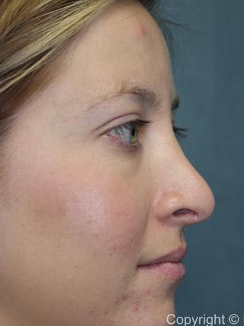 Rhinoplasty Before & After Patient #1742