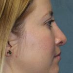 Rhinoplasty Before & After Patient #1742