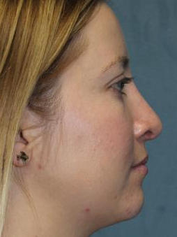 Rhinoplasty Before & After Patient #1742