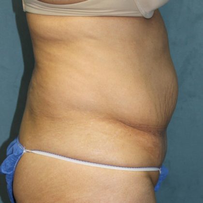 Tummy Tuck Before & After Patient #1832