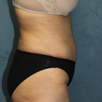 Tummy Tuck Before & After Patient #1832