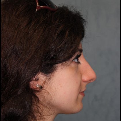 Rhinoplasty Before & After Patient #1509