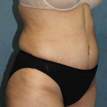 Tummy Tuck Before & After Patient #1832