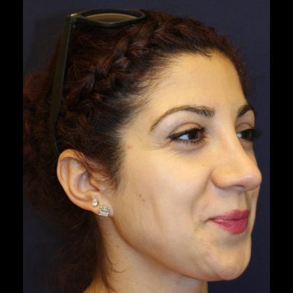 Rhinoplasty Before & After Patient #1509