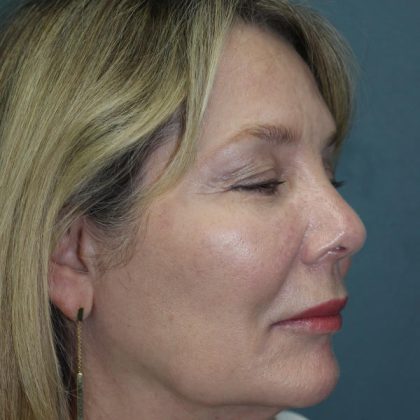 Rhinoplasty Before & After Patient #1769