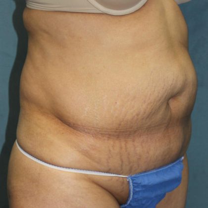 Tummy Tuck Before & After Patient #1832