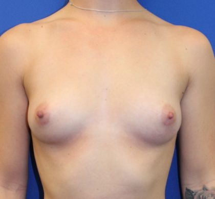 Breast Augmentation Before & After Patient #3607