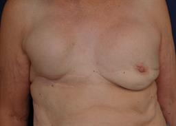 Breast Revision Before & After Patient #4708