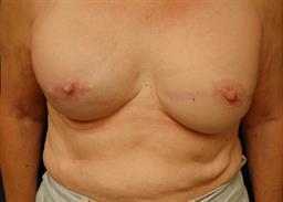 Breast Revision Before & After Patient #4708