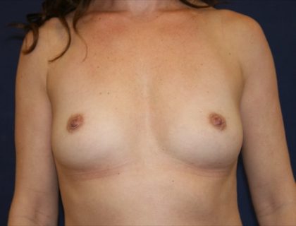 Breast Augmentation Before & After Patient #3586
