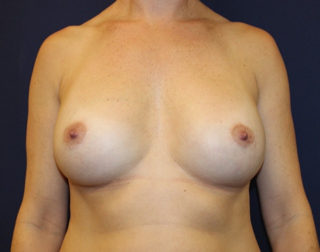Breast Augmentation Before & After Patient #3586