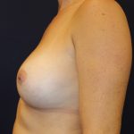 Breast Augmentation Before & After Patient #3586