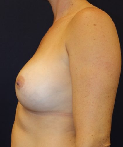 Breast Augmentation Before & After Patient #3586