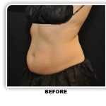 Coolsculpting Before & After Patient #4798