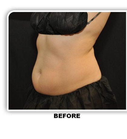Coolsculpting Before & After Patient #4798